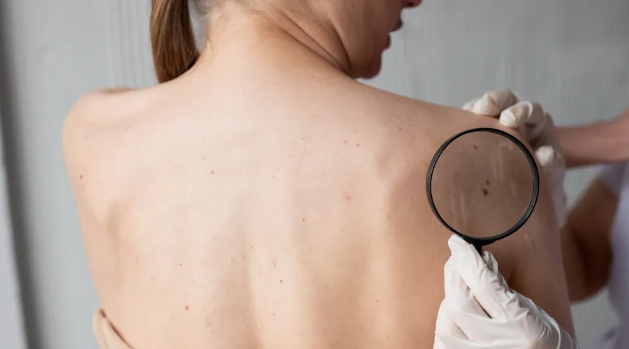 Bakanlıktan Cilt Kanseri Uyarısı: Güneşten Korunun, Erken Teşhis Hayati Önem Taşıyor!