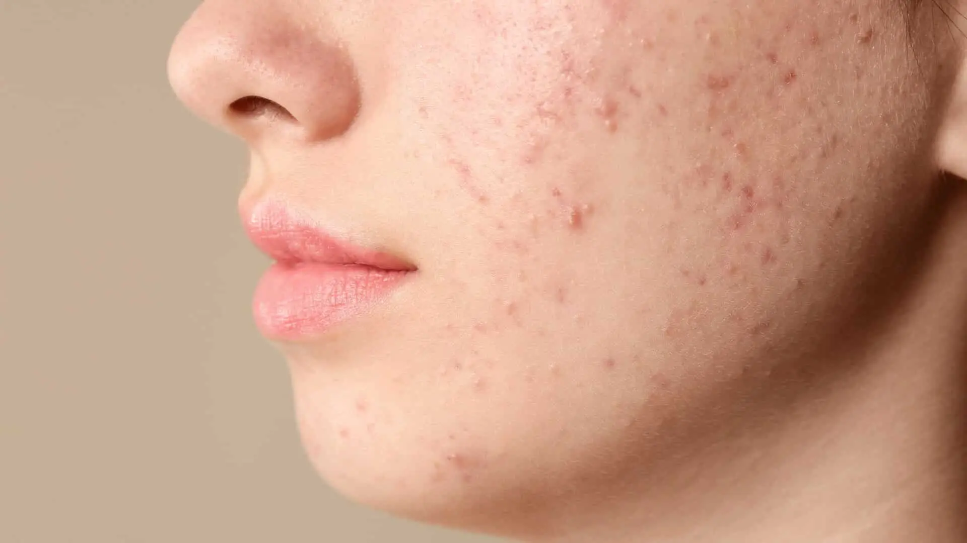 Geçmeyen Sivilcenin Nedeni Araştırılmalı