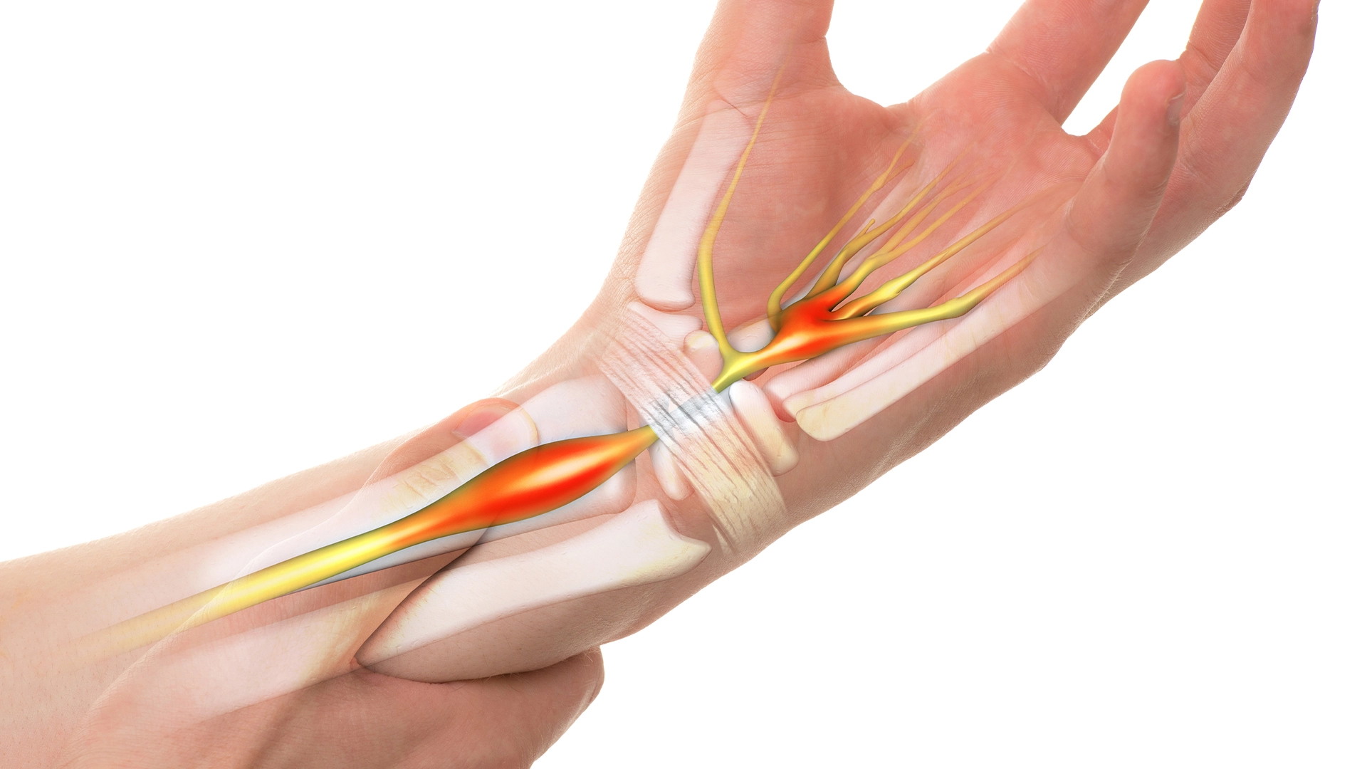 Ellerinizdeki Uyuşma ve Karıncalanma: Karpal Tünel Sendromu ve Diğer Nedenler