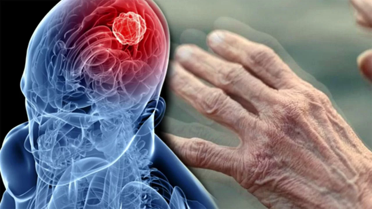 Parkinson Hastaları Umutsuzluğa Kapılmamalı