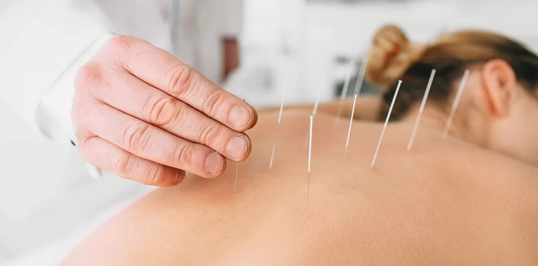 Vücudun Gizli Eczanesi: Akupunktur