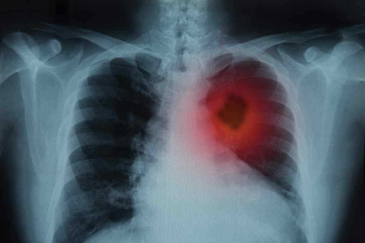Akciğer Kanserli Hastalar Bu Belirtilere Dikkat!