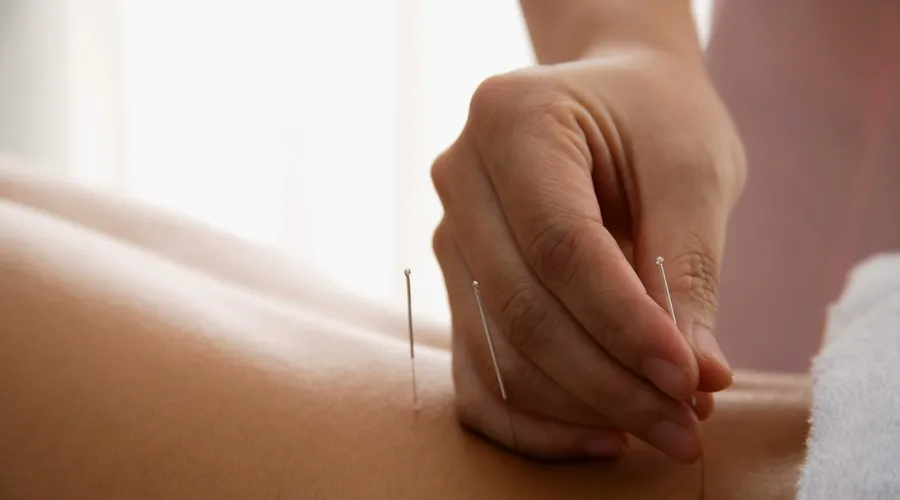 Sağlık İçin Akupunktur: Etkileri ve Faydaları